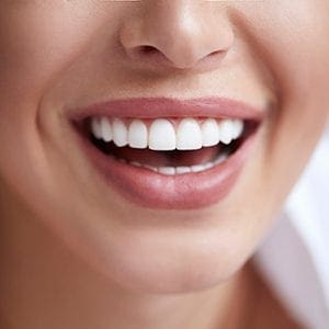 veneers veneers